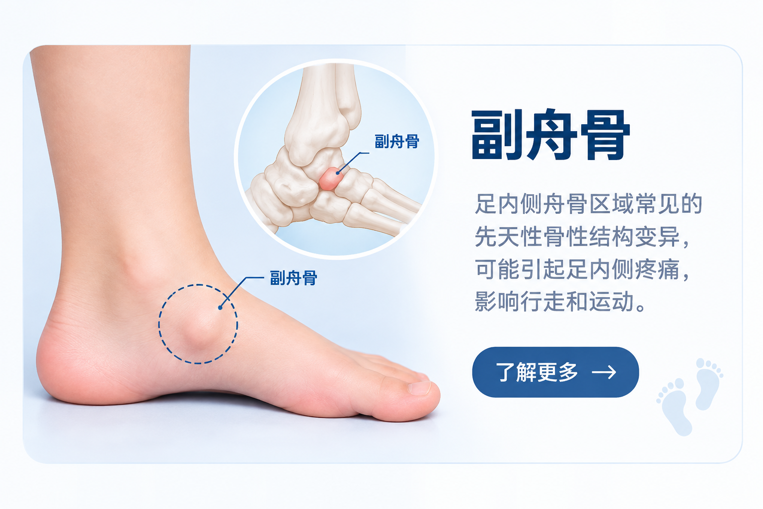 儿童副舟骨