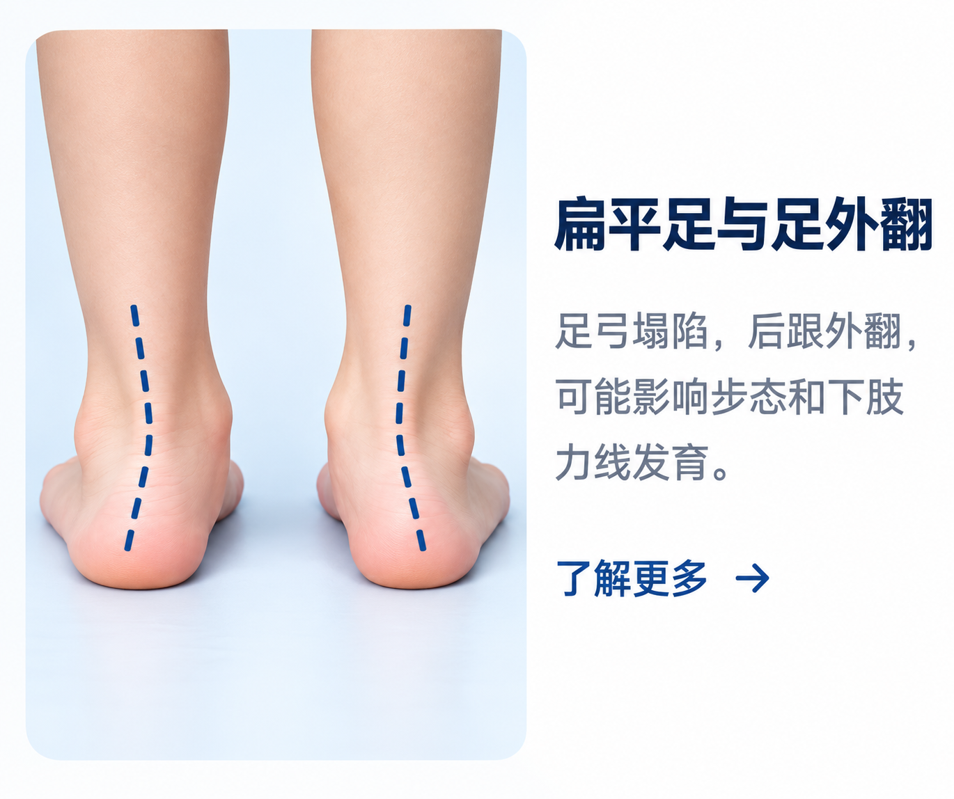儿童扁平足与足外翻