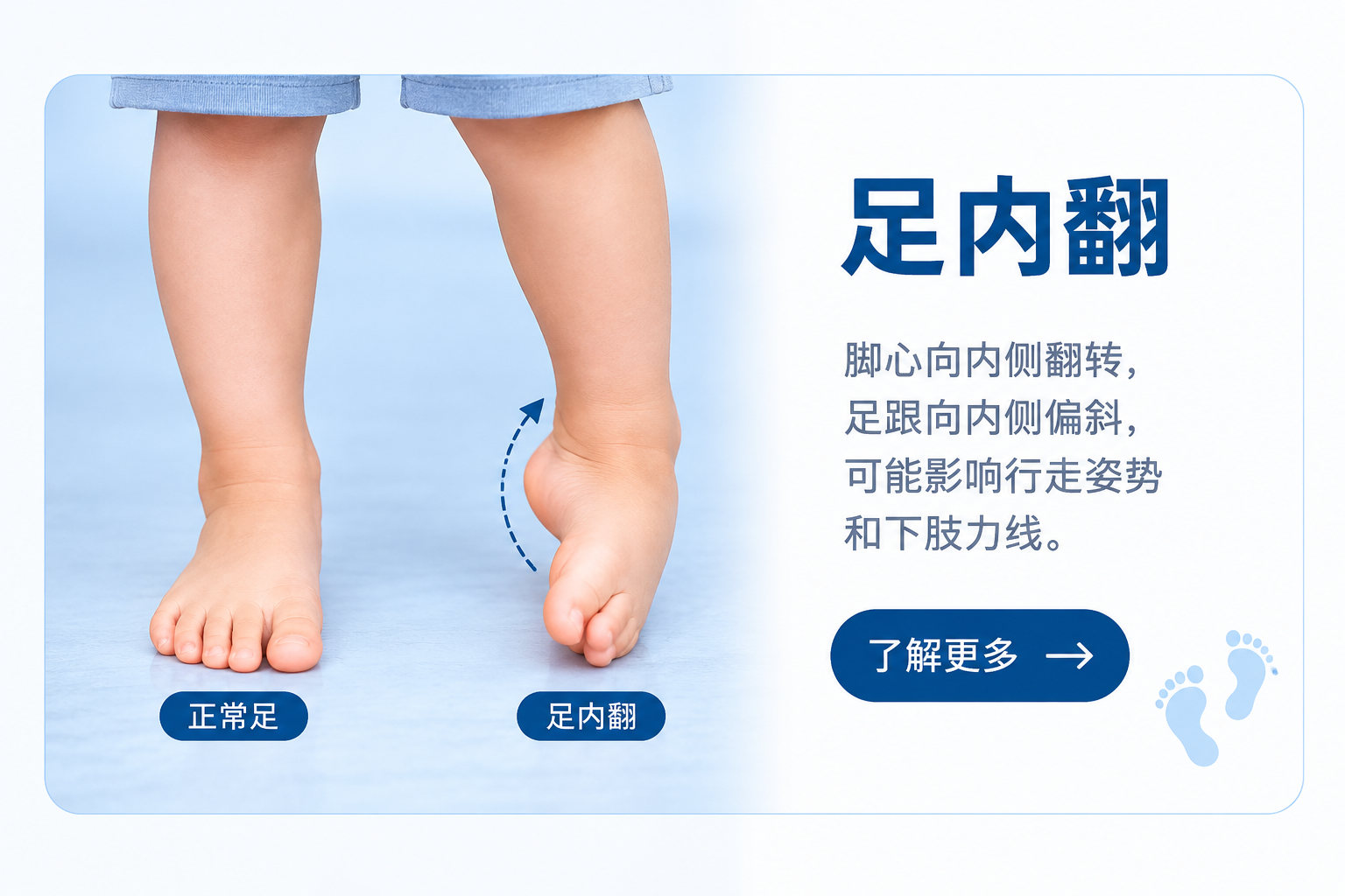 儿童足内翻
