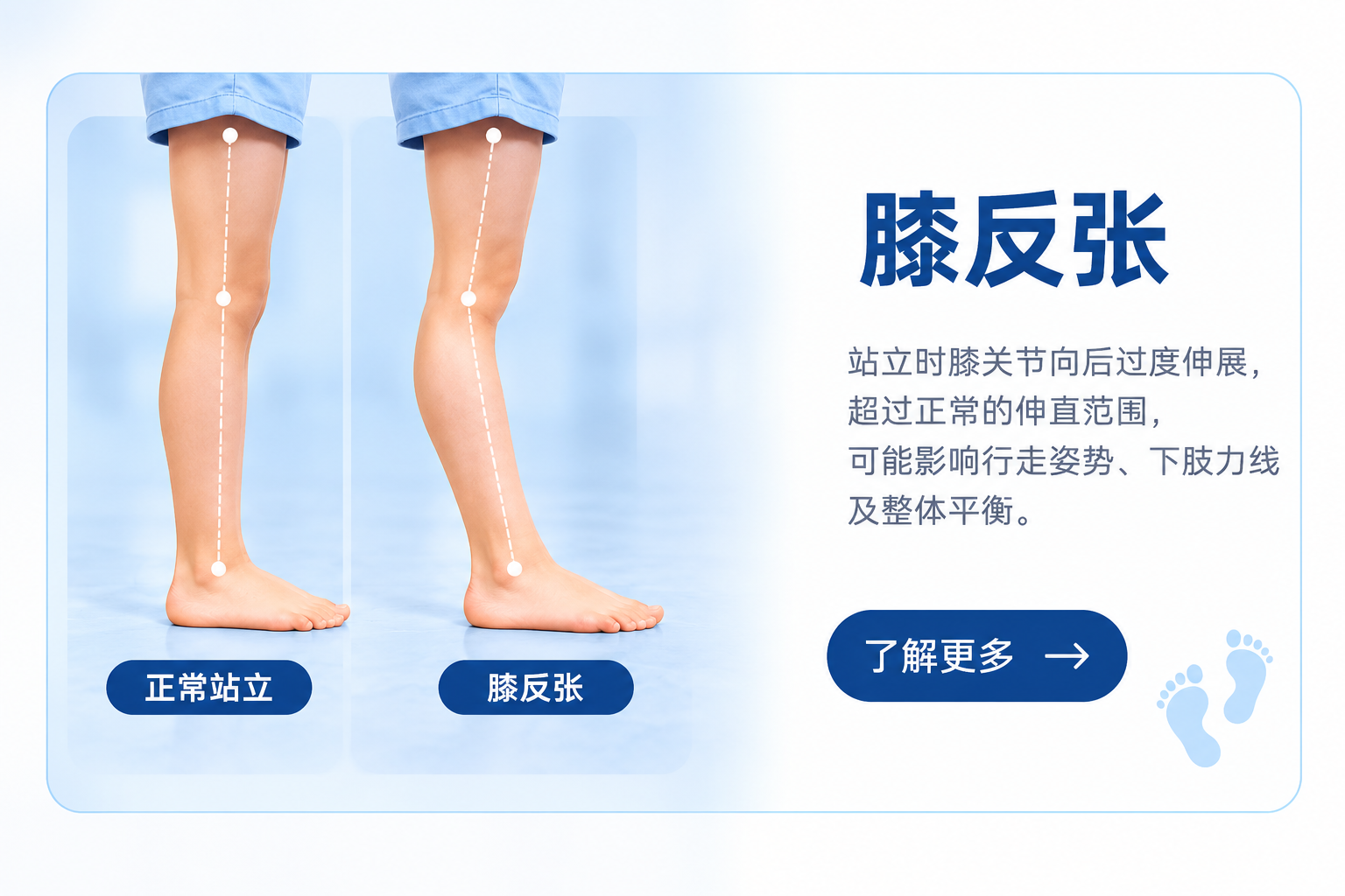 儿童膝反张