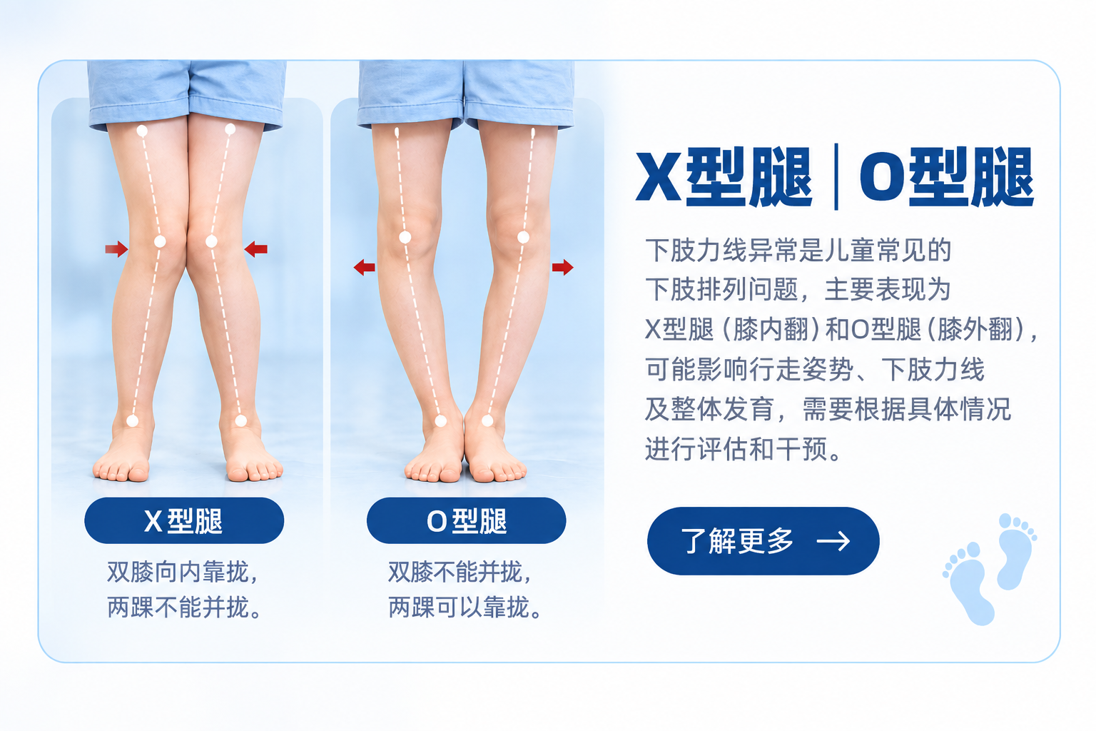 儿童X型腿与O型腿